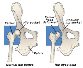 hip dysplasia diagram